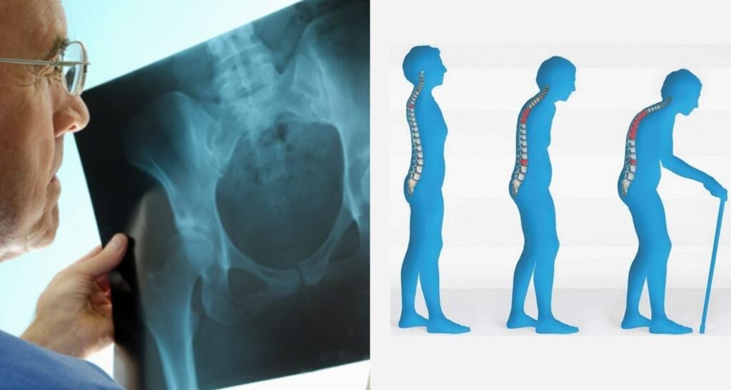 Managing Osteoporosis: How Allied Health Professionals can help keep bones healthy